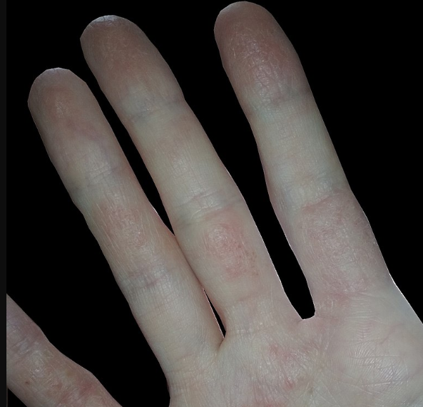 Названы 7 причин облезающей кожи на ладонях и стопах