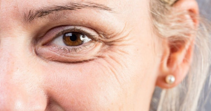 Как избавиться от всех типов мимических морщин и гусиных лапок вокруг глаз