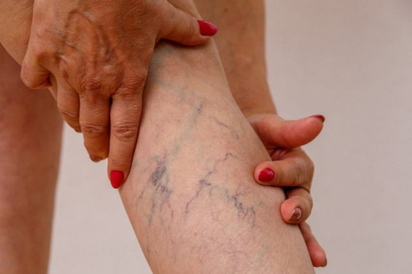 Sport24.ru рассказал об опасности варикоза для жизни