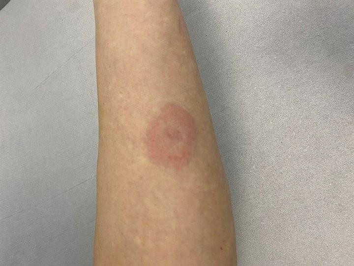 Врач Малышева заявила, что на месте укуса боррелиозного клеща появляется отметина в виде мишени