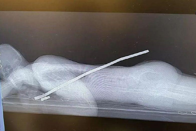 В Сочи врачи спасли мужчину с куском арматуры в грудной клетке