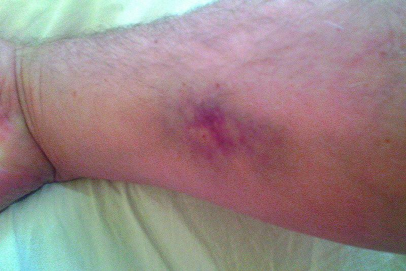 Хирург Тарабарин: Обширные синяки на теле могут грозить нагноением