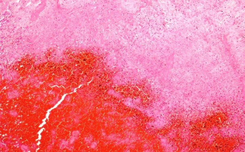 Доктор Мясников описал профилактику появления тромбов