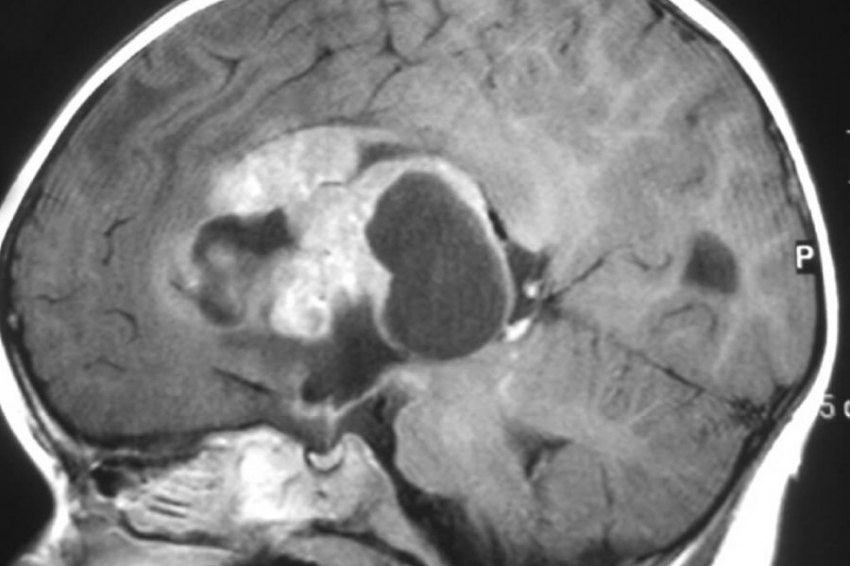 Онколог РФ Борзяница перечислил семь симптомов рака мозга