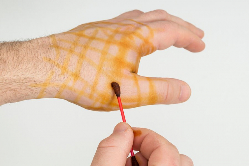 Эндокринолог Катхурия: сетка из йода не восполнит дефицита вещества в организме