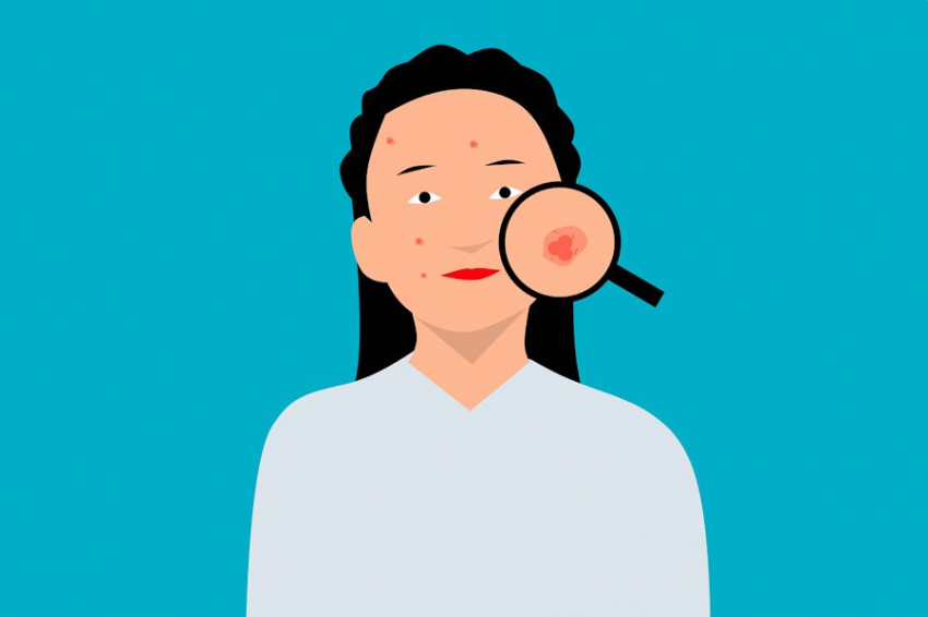 Бактерии защитят нашу кожу от образования угрей