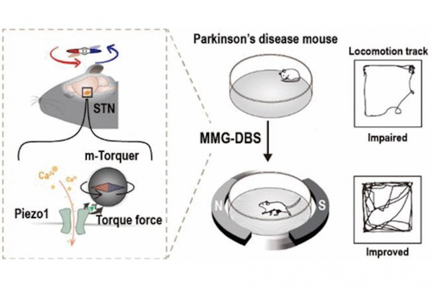 Корейцы лечат болезнь Паркинсона с использованием неинвазивного нейростимулятора