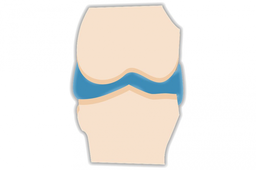 Ученые США разработали щадящий метод лечения коленного сустава
